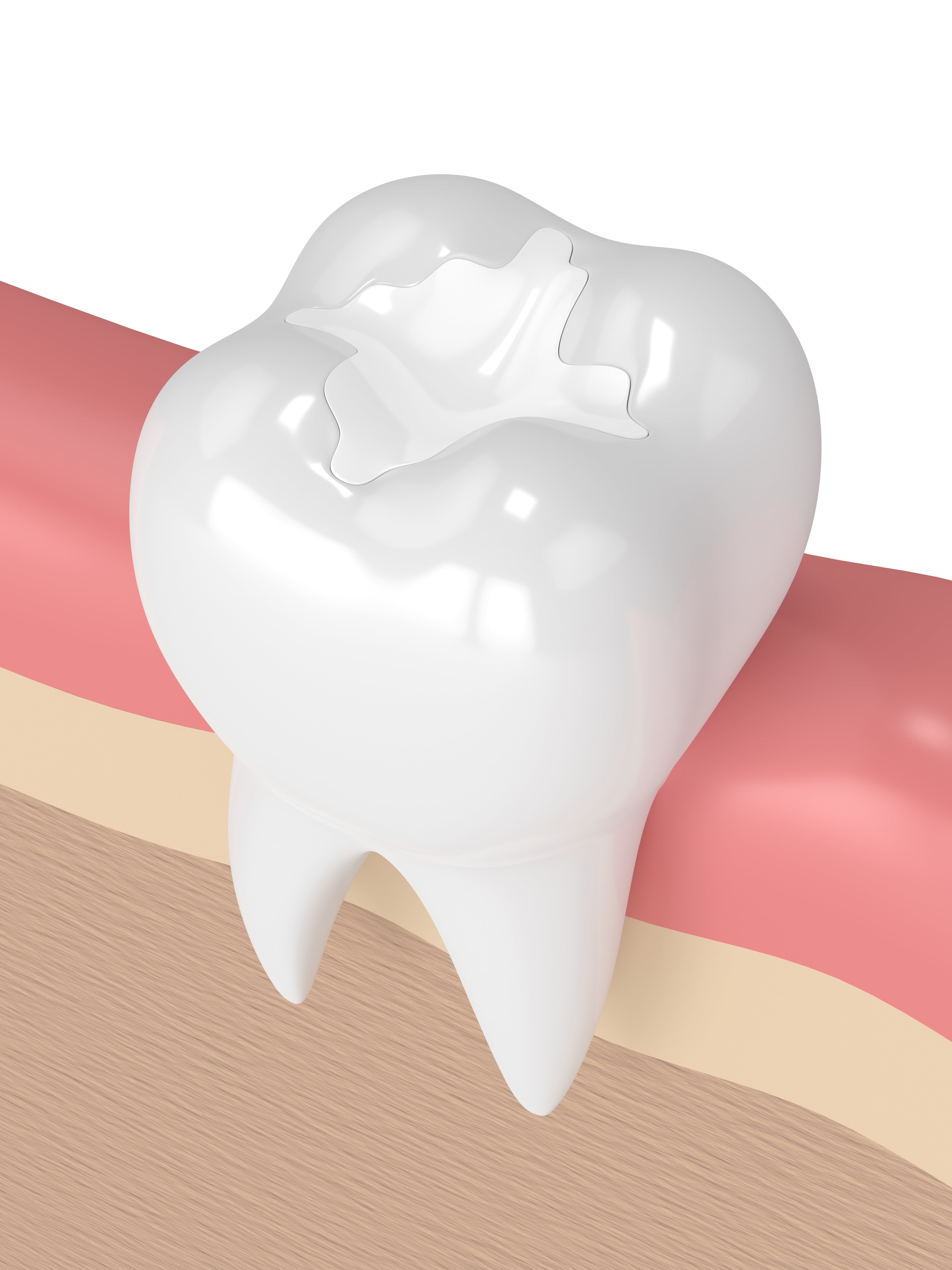 3-D image of a composite filling in a tooth