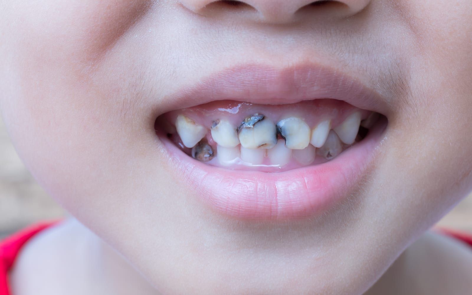 Child with decaying teeth