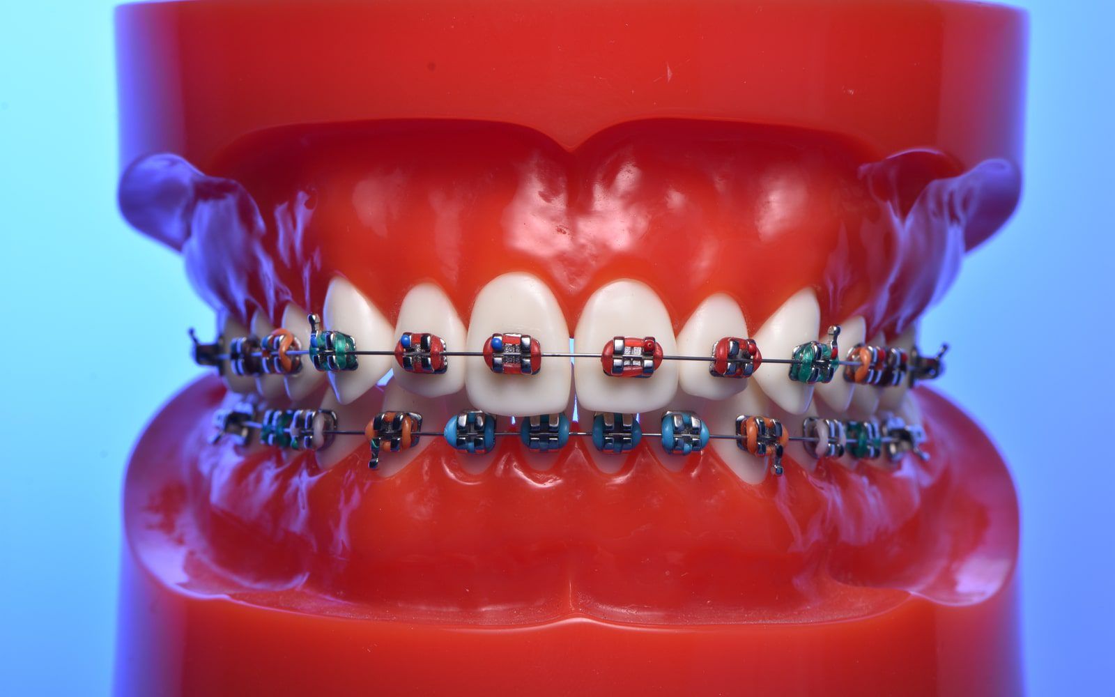 Dental Model Braces