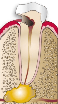 Severely decayed tooth diagram