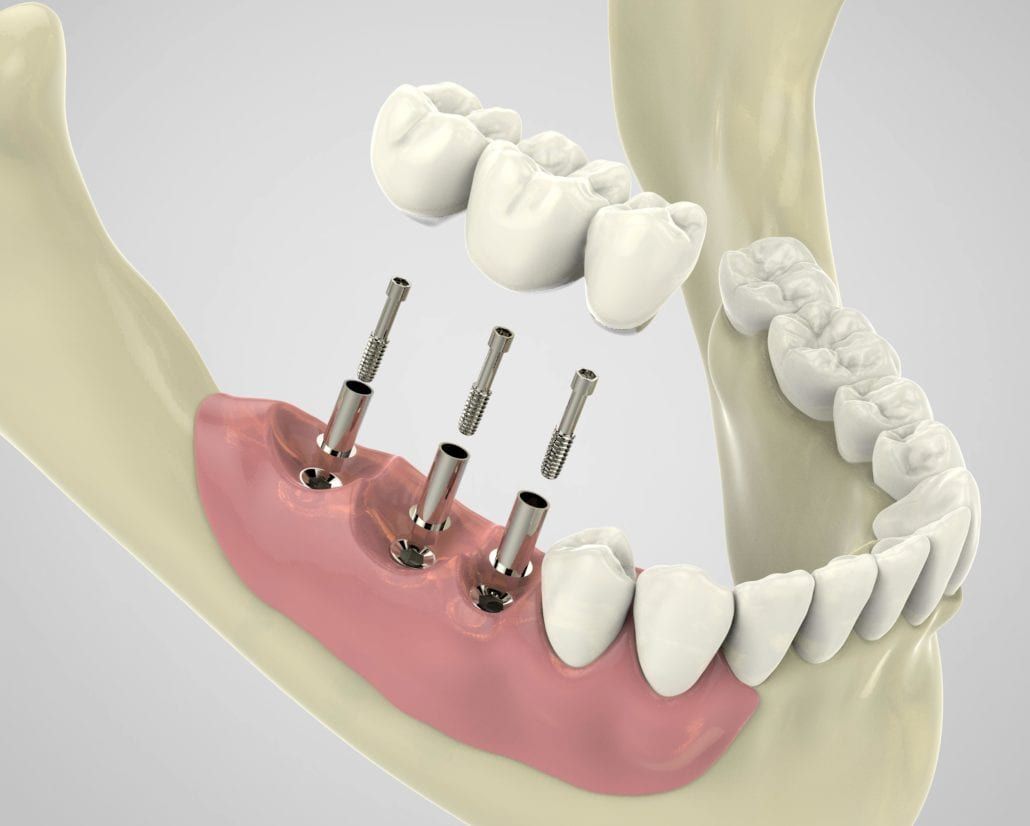 three dental implants shown towards the back of the mouth