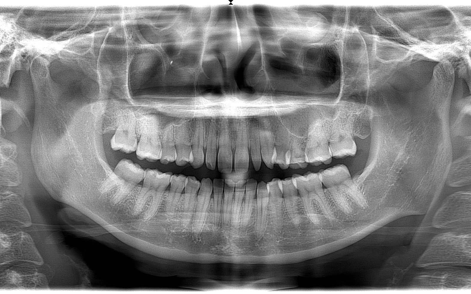 Peg Lateral Incisors shown on X-Ray Scan