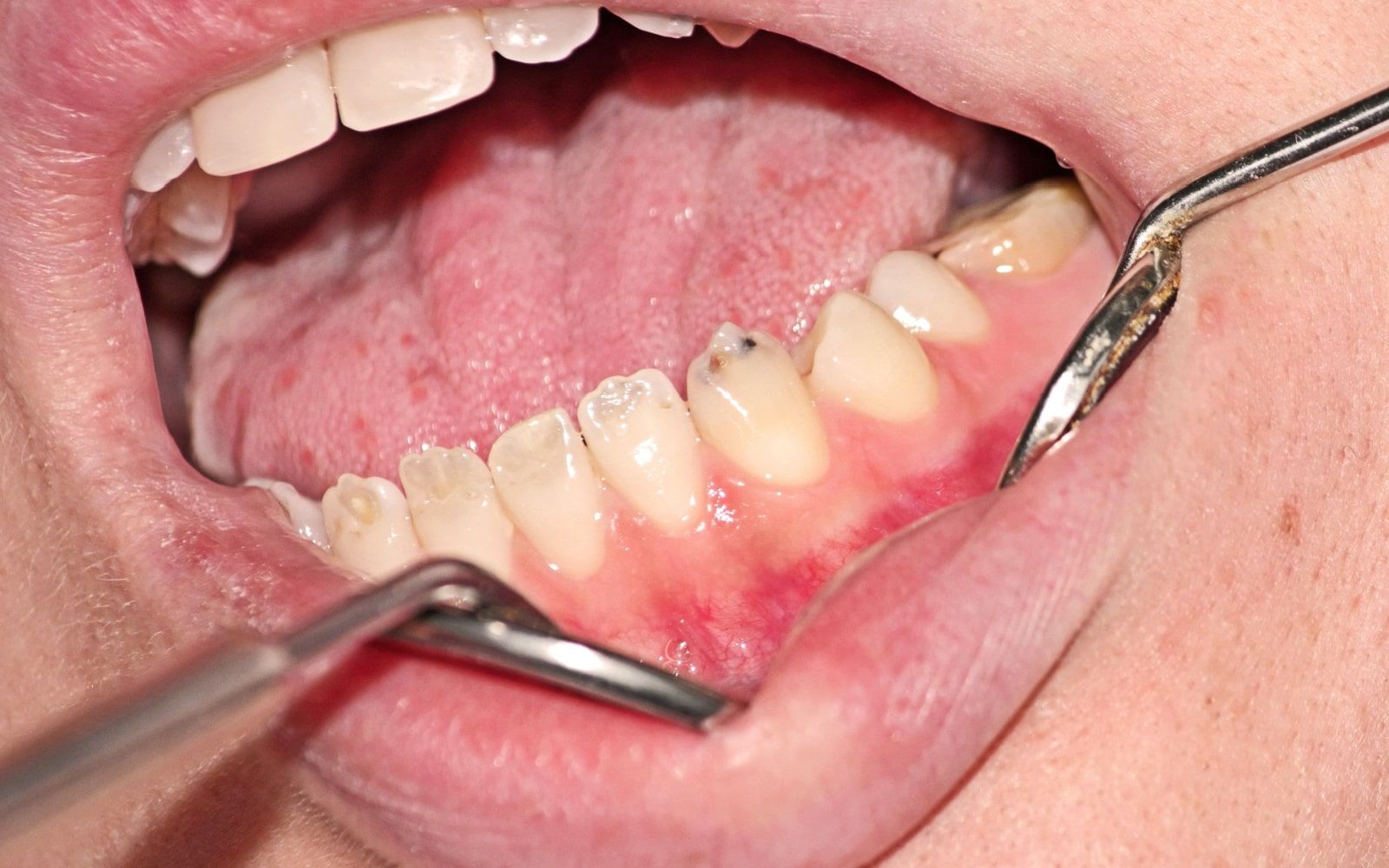 Dentinogenesis Imperfecta Symptoms