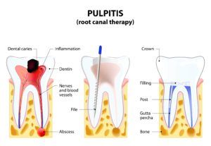 diagram showing the various steps of the root canal process