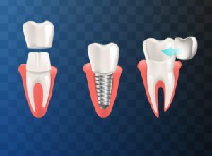 Dental crown, implant, and veneer