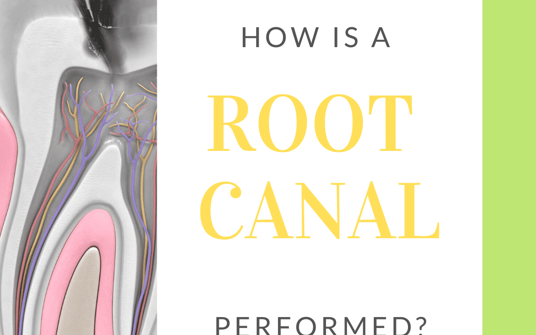 How is a Root Canal Performed?