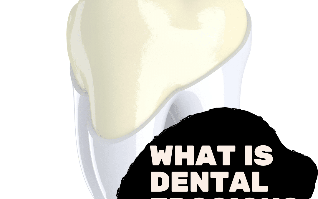What is Dental Erosion?