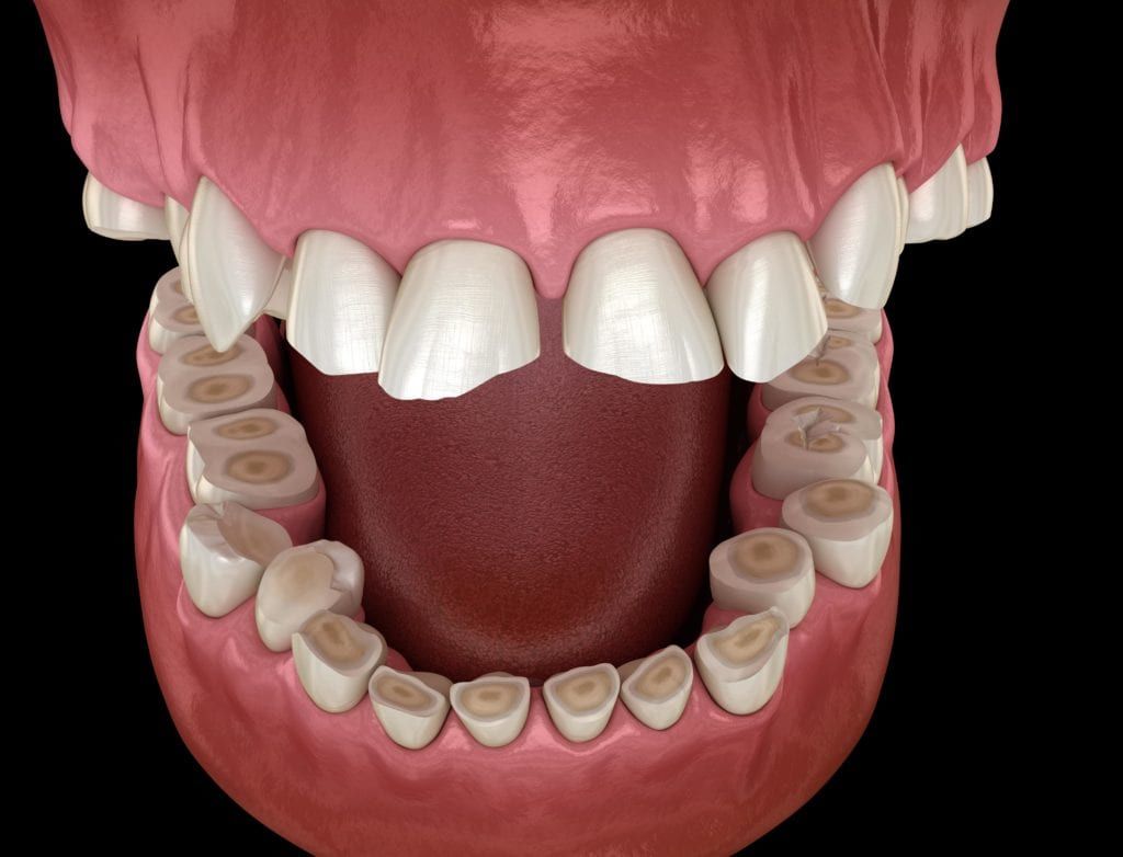tooth enamel erosion from bruxism
