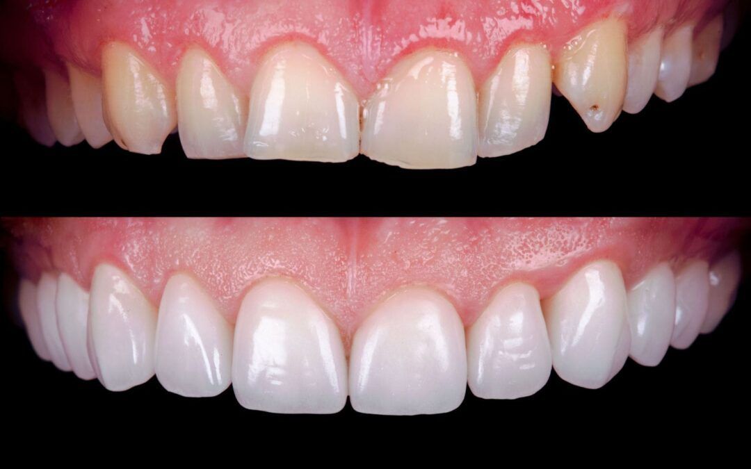 How Direct Dental Restorations Can Address Dental Trauma