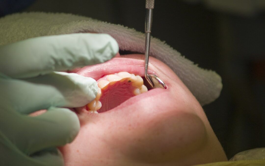 Can Dentists Fix Perforated Sinus After Dental Implant Surgery?