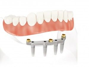 Dental Lab-Service-Quality-Portland-OR-Artisan-Dental-Laboratory-ImplantsMilled_Bar_Locators_NobelReplace_2