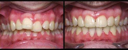 teeth_before_and_after_braces