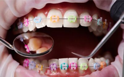 Why Mail-In Orthodontic Aligners Can Worsen Your Oral Health