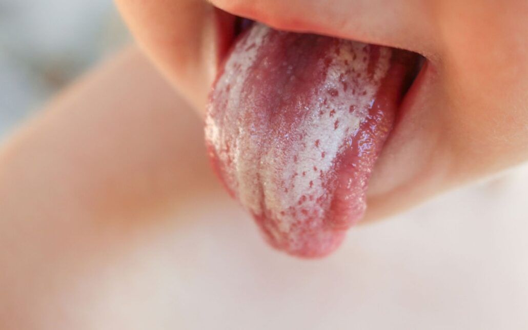 Oral Thrush