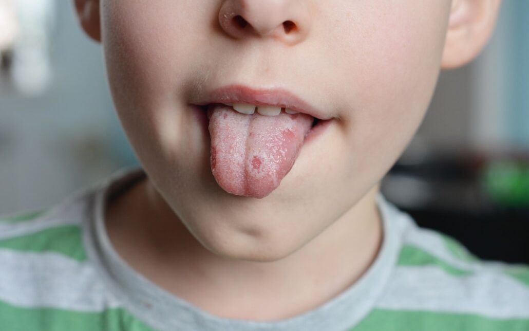 Child with salivary gland disorder problems