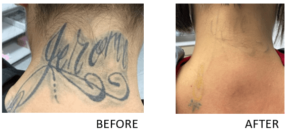 Discover 120+ new skin tattoo removal super hot