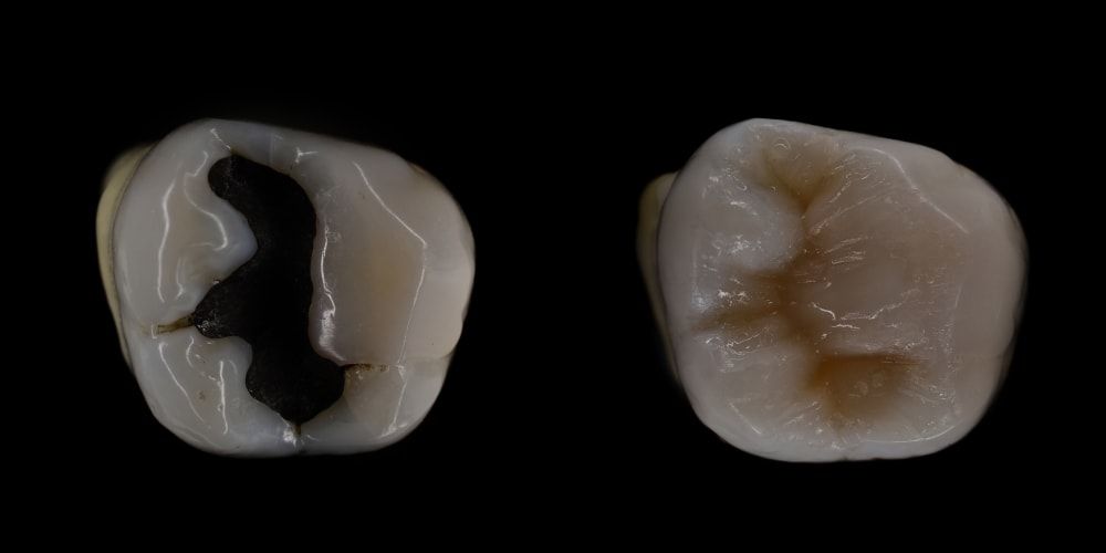 Composite filling on a tooth against a black background