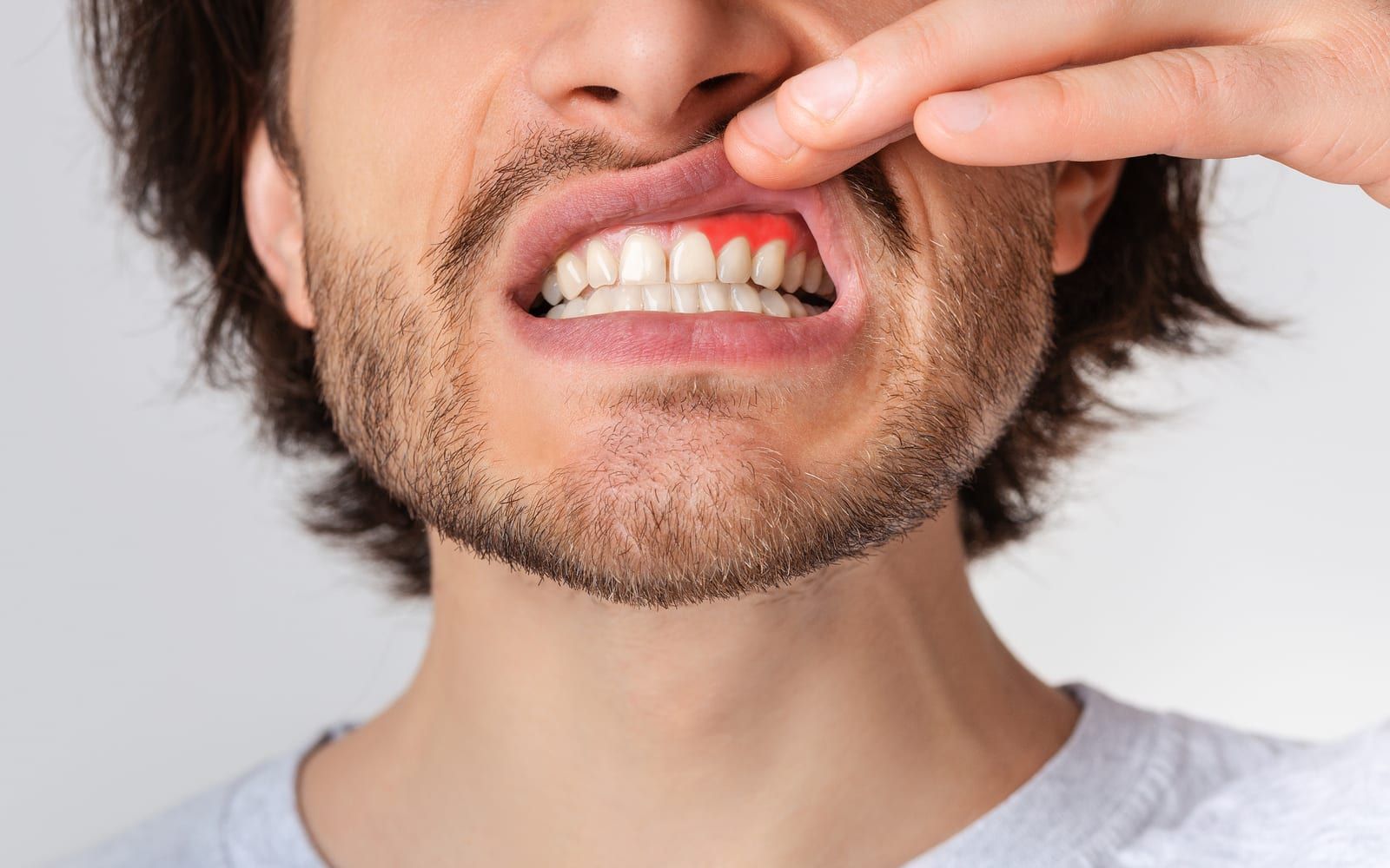 Man revealing gums with periodontal disease